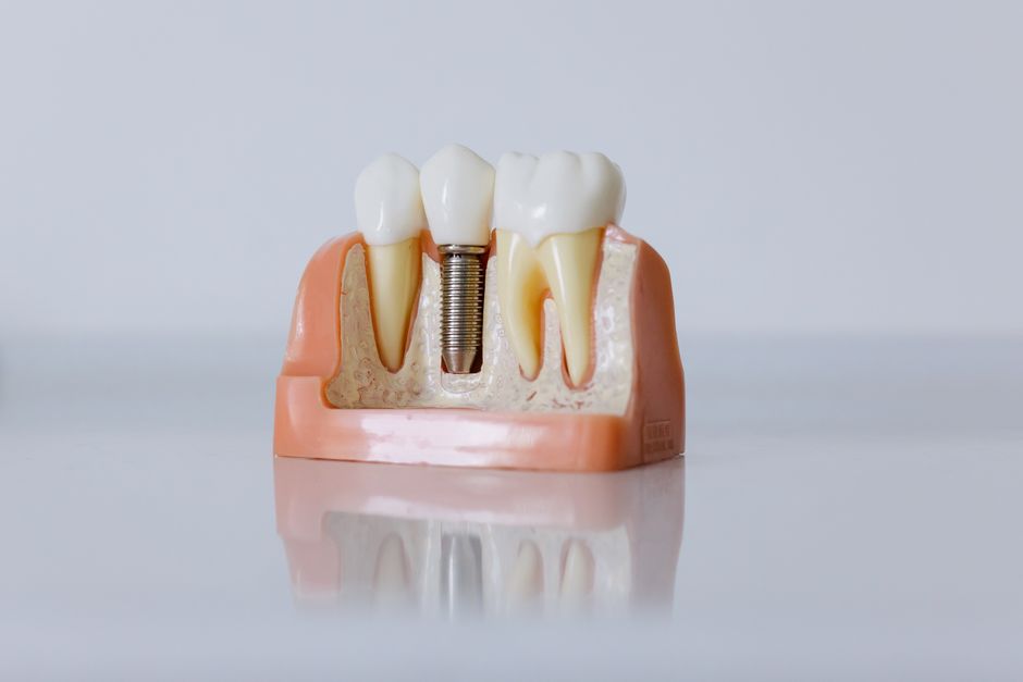 Zobni implantat